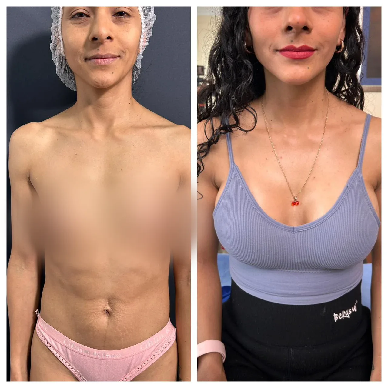 Antes y después de aumento de mamas con más volumen y escote — caso real Dra. Martínez