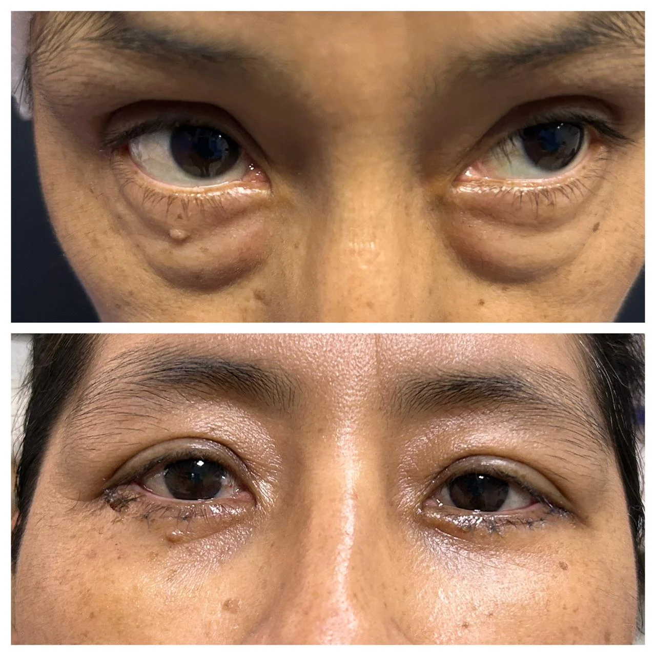 Antes y después de blefaroplastía por mirada cansada y párpados flácidos — caso real Dra. Martínez