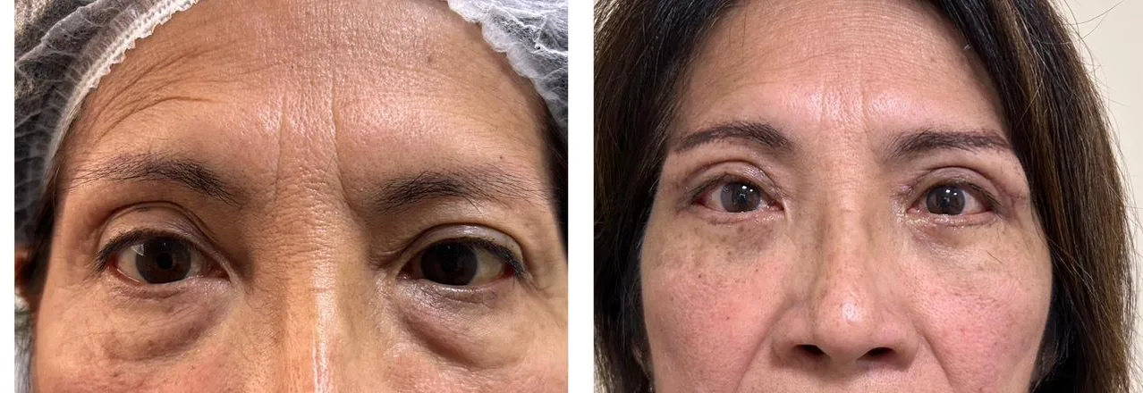 Antes y después de blefaroplastía completa — caso real Dra. Martínez
