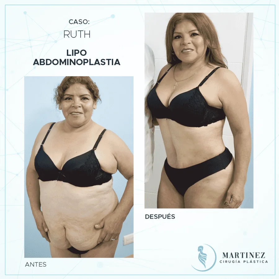 Antes y después de abdominoplastía por exceso de piel — caso real Dra. Martínez