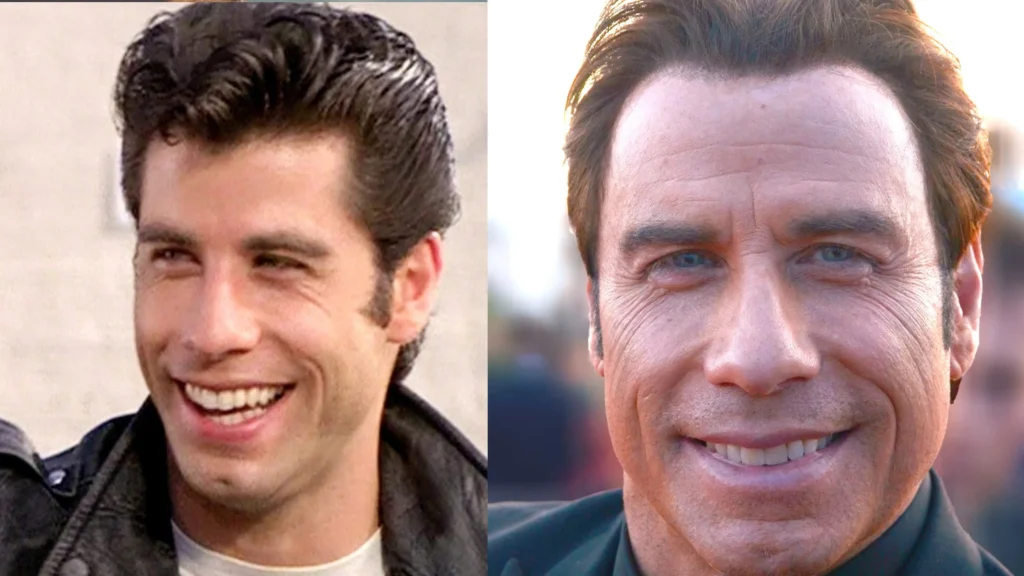 John Travolta, cirugía antes y después