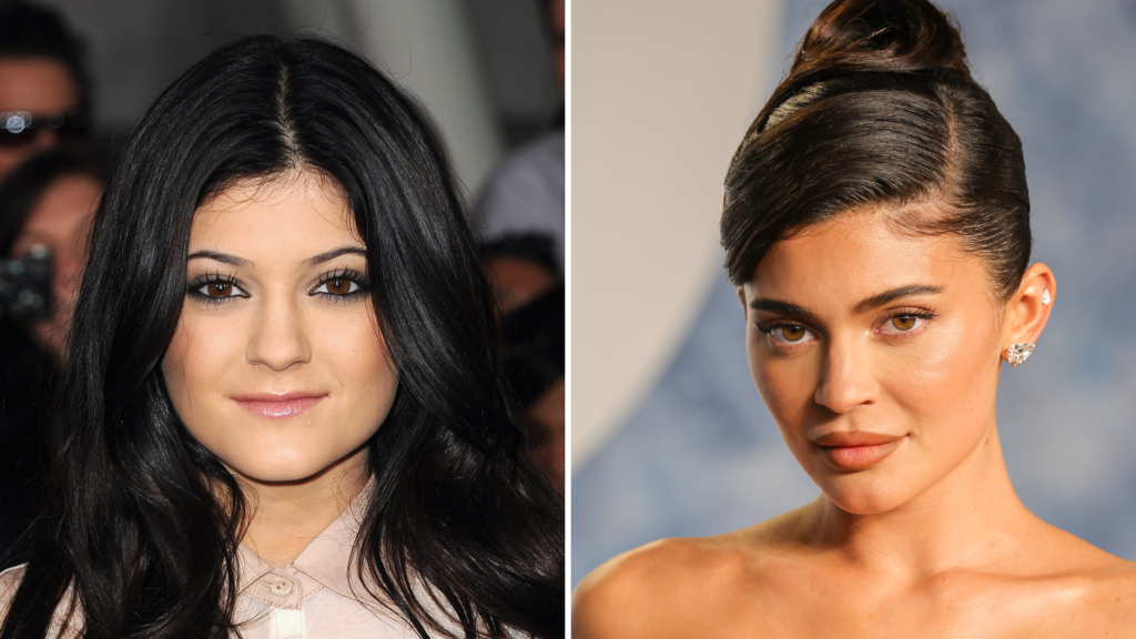 Kylie Jenner, aumento de labios, antes y después