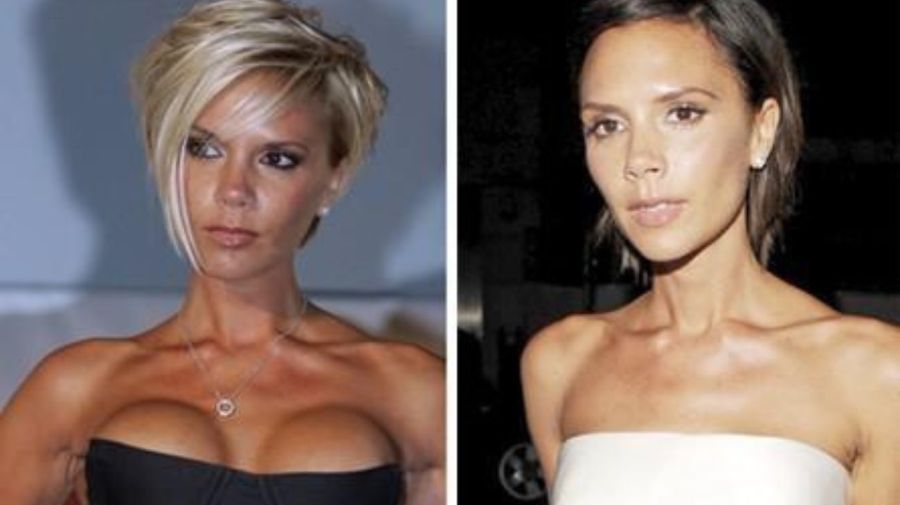 Victoria Beckham, aumento de mamas antes y después