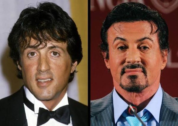 Sylvester Stallone, cirugía antes y después