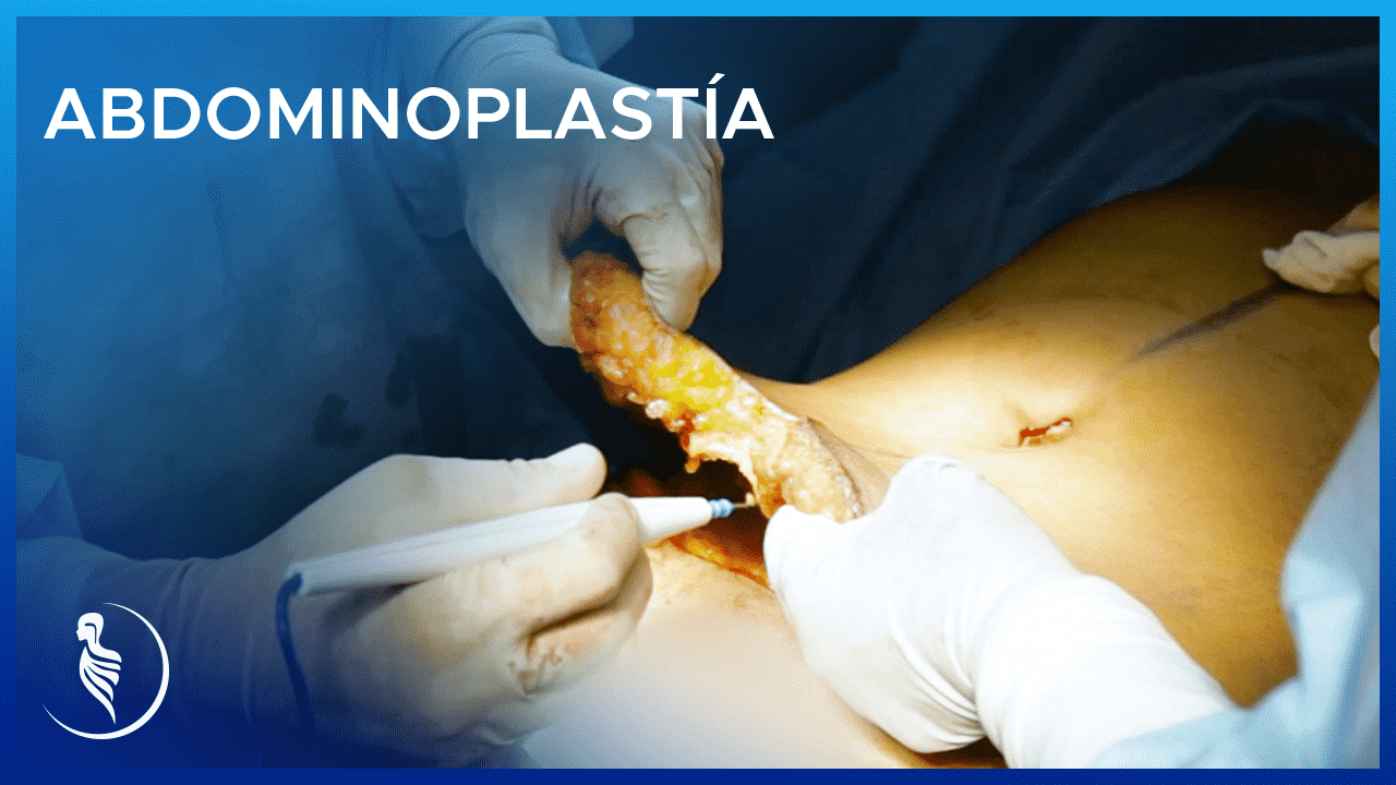Abdominoplastia: Cirugía de Abdomen en Lima Perú