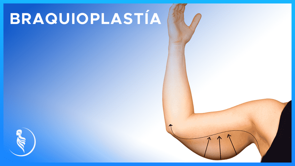 Resultado braquioplastia