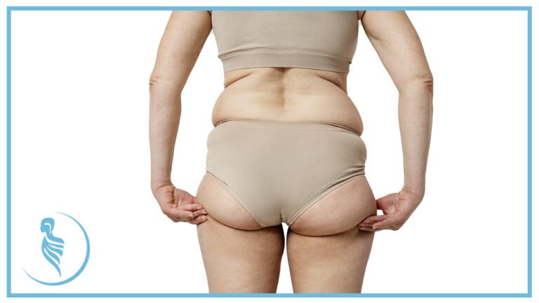 Lipedema: Una Condición Desconocida que Afecta a la Salud de las Mujeres