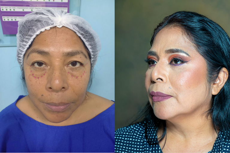 Antes y después de blefaroplastia