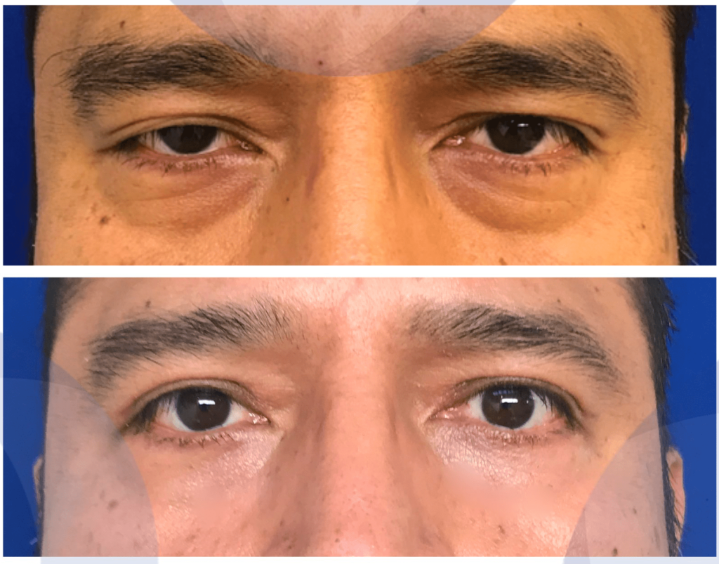 Paciente viendo los resultados de su rejuvenecimiento de la mirada en Lima.