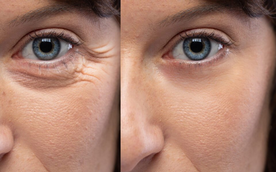 ¿Cuál es el efecto de una Blefaroplastia?