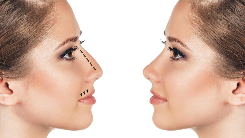 Proceso de rinomodelación, una alternativa en la comparativa de rinomodelación vs rinoplastia.