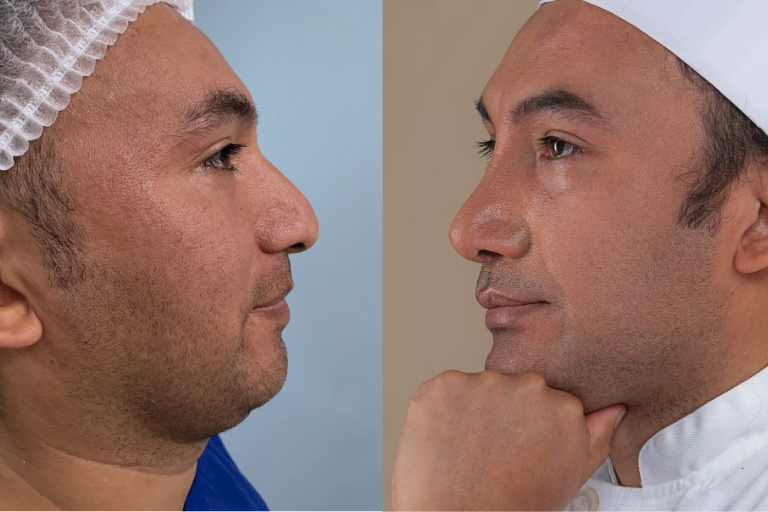 Cuánto cuesta una Rinoplastía en Perú 2025