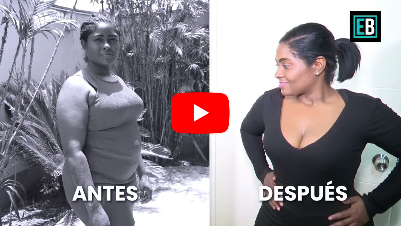 Resultado real de Mommy Makeover en Lima — Dra. Martínez (caso 3)