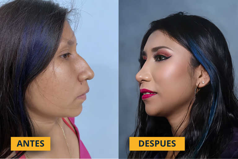 Rinoplastia masculina antes y después
