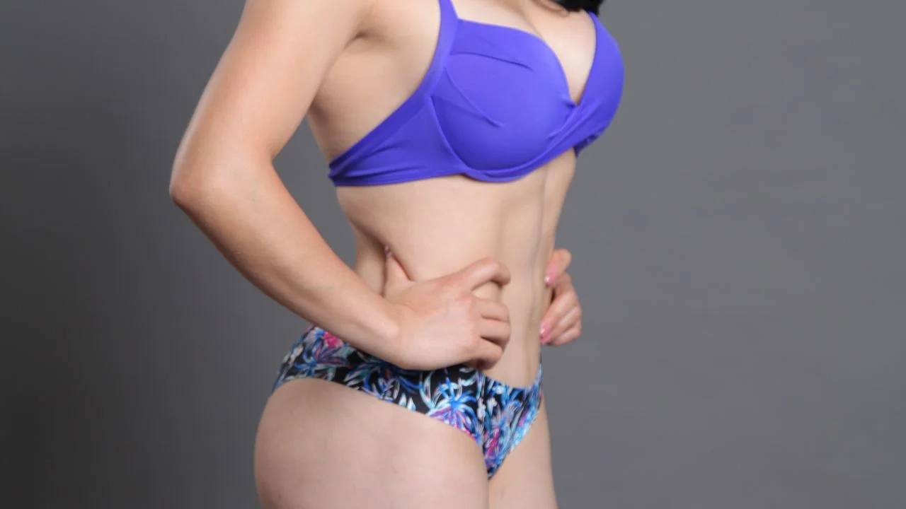 Resultado real de Mommy Makeover en Lima — Dra. Martínez (caso 2)