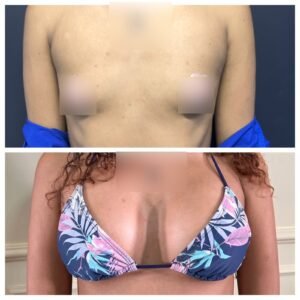 Antes y después de operación de aumento de mamas