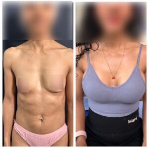 Cómo es un antes y después de aumento de mamas