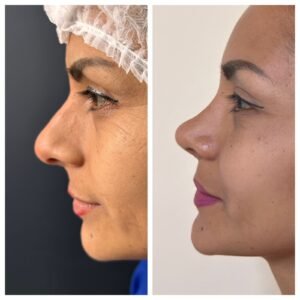 Rinoplastía antes y después