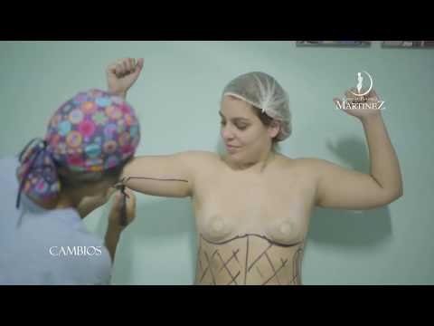 Lipoescultura + Aumento de Mamas en Lima: El Cambio de Carla | Cirugía Plástica Martínez — Cirugía Plástica Martínez