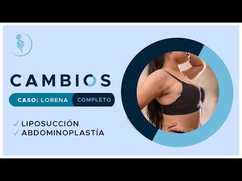 Programa Cambios| Liposucción, Abdominoplastía de Lorena (Caso completo) — Cirugía Plástica Martínez