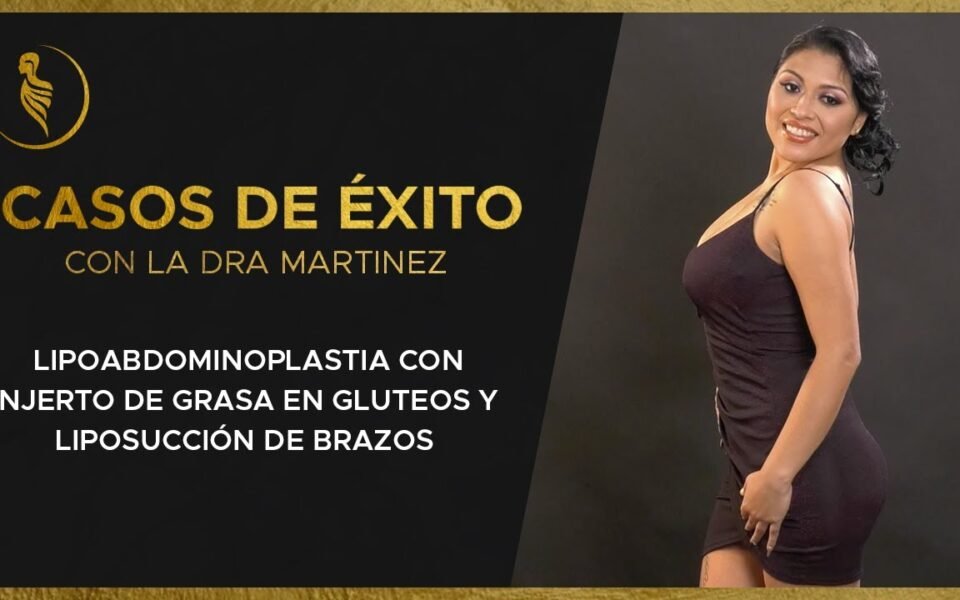 Caso de éxito de Sheyla: lipoabdominoplastia y liposucción de brazos