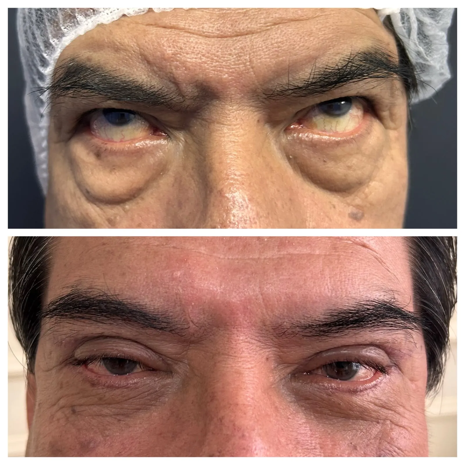 Antes y después de Blefaroplastía — caso real Dra. Martínez (2)