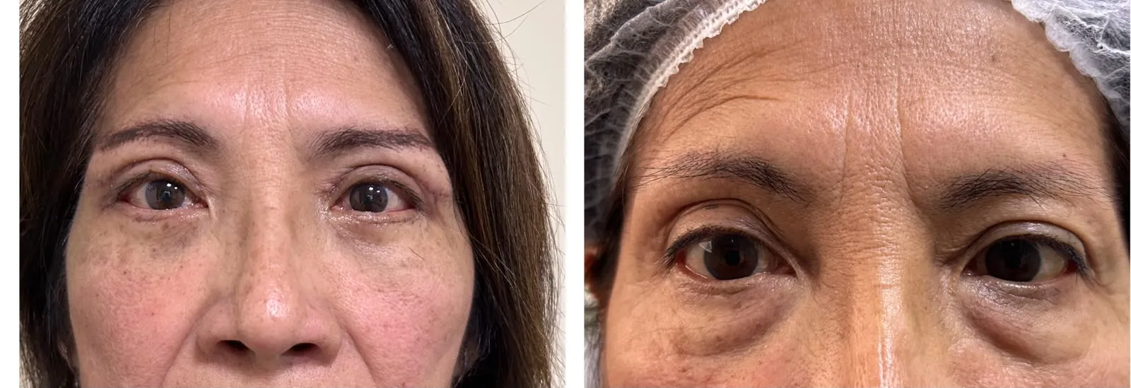Antes y después de Blefaroplastía — caso real Dra. Martínez (4)