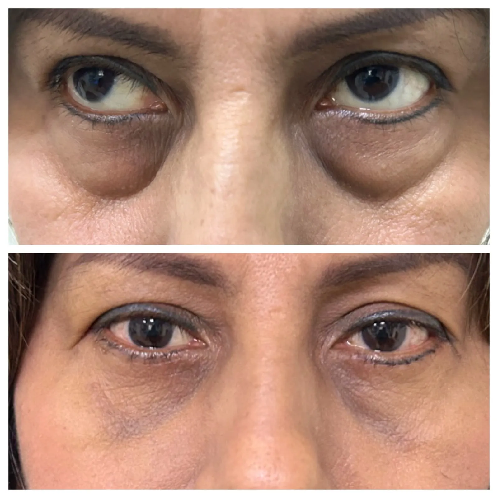 Antes y después de Blefaroplastía — caso real Dra. Martínez (5)