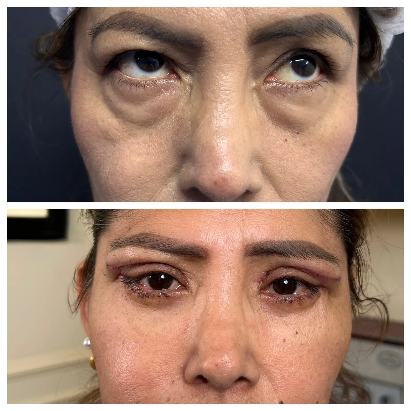 Antes y después de Blefaroplastía — caso real Dra. Martínez (6)