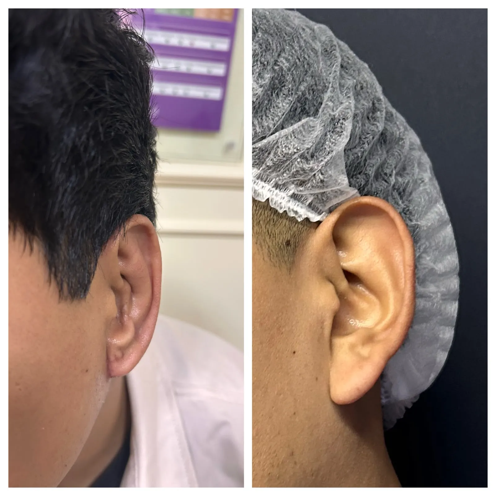 Antes y después de Otoplastía — caso real Dra. Martínez (1)