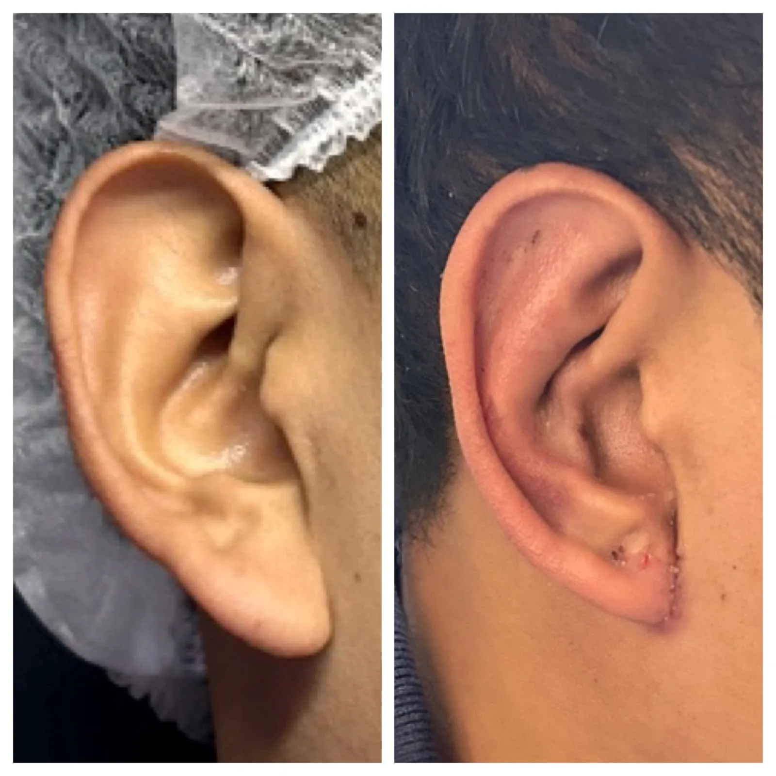 Antes y después de Otoplastía — caso real Dra. Martínez (2)