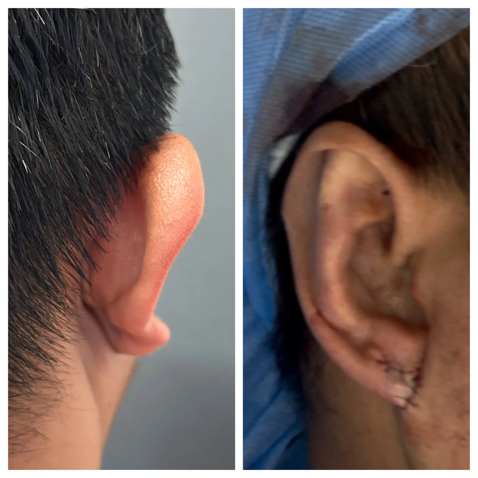 Antes y después de Otoplastía — caso real Dra. Martínez (3)