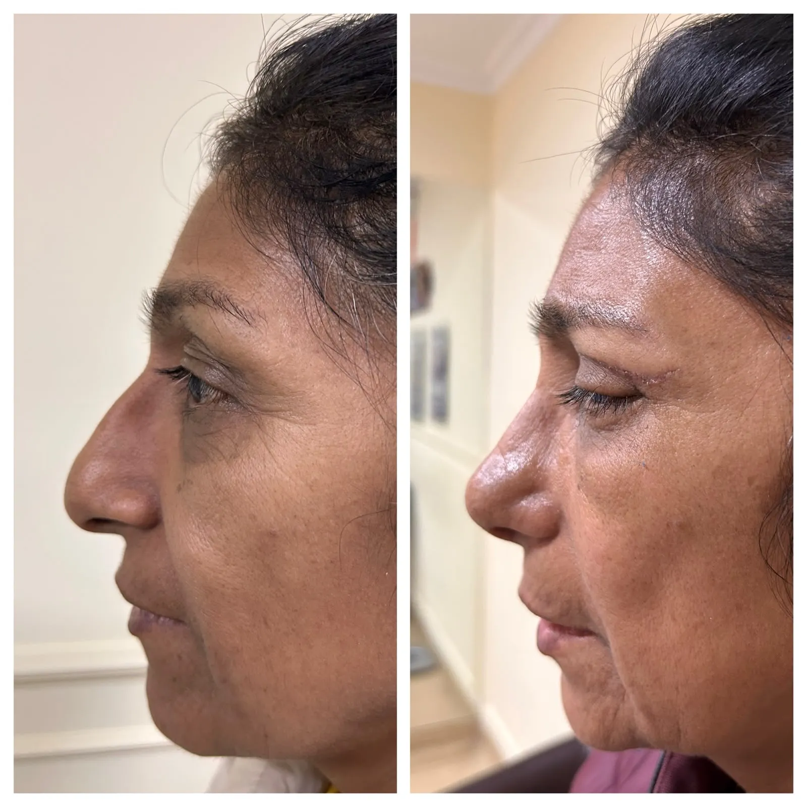 Antes y después de Rinoplastía — caso real Dra. Martínez (3)