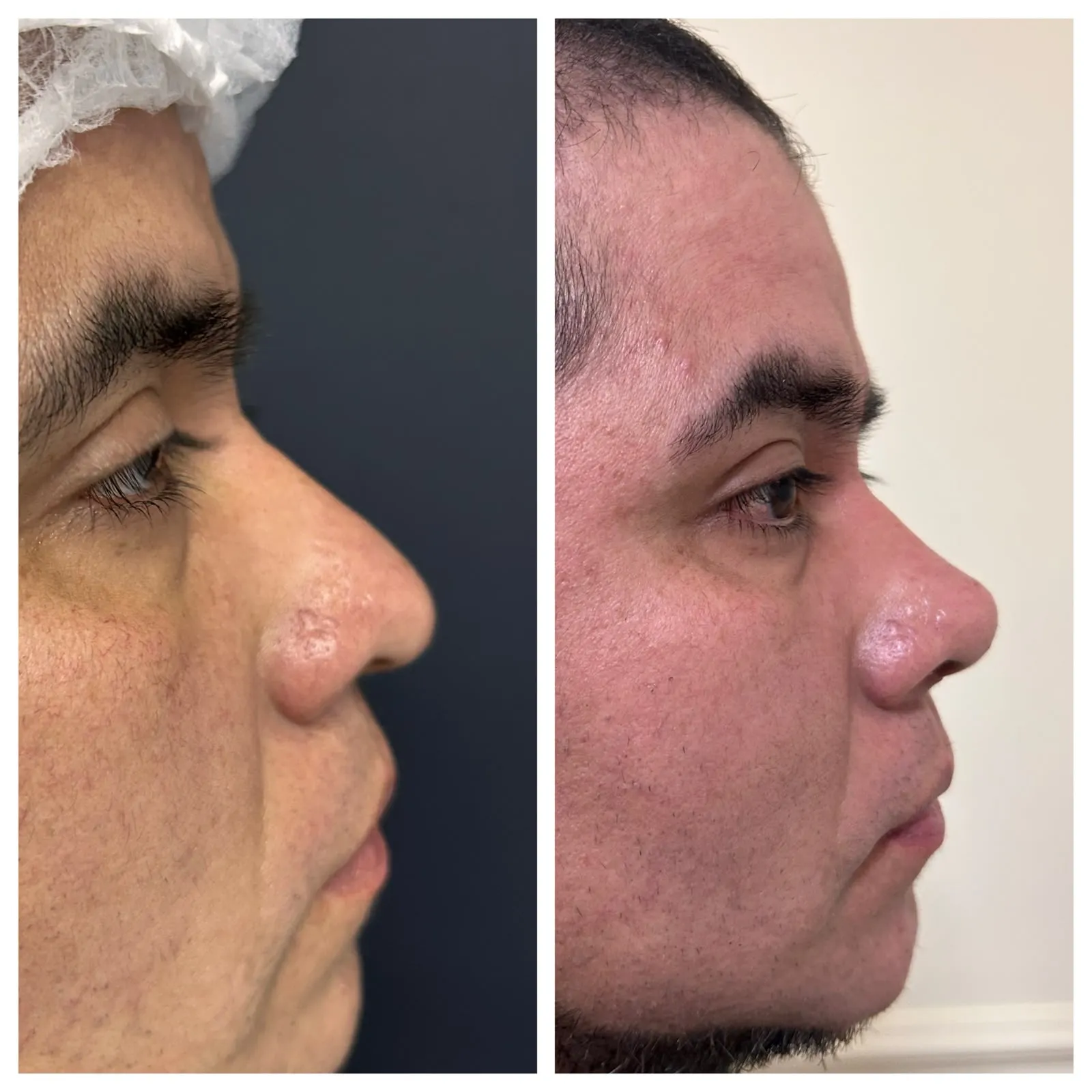 Antes y después de Rinoplastía — caso real Dra. Martínez (11)