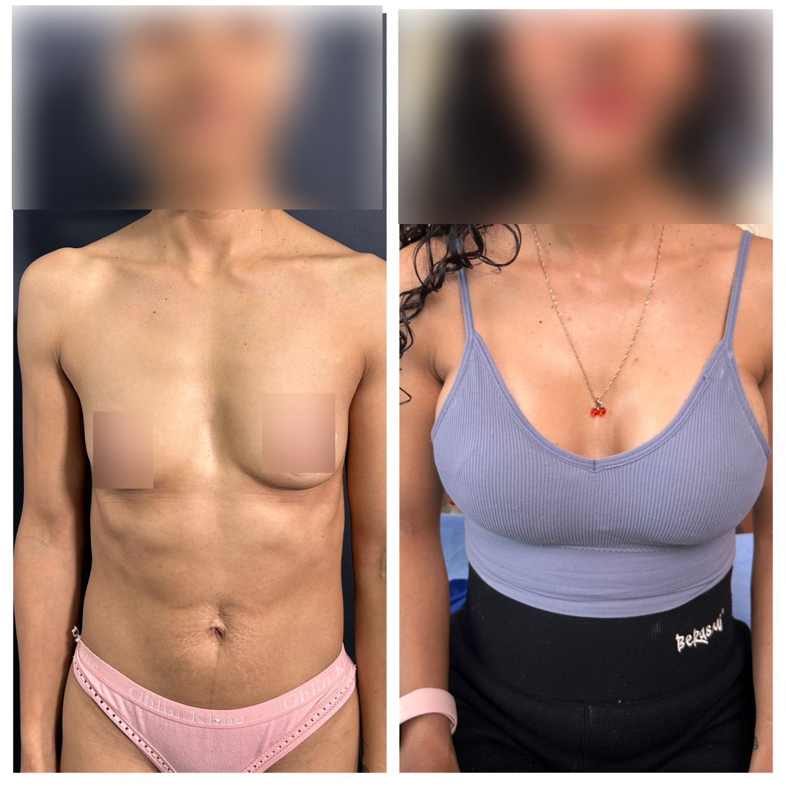 Cómo es un antes y después de aumento de mamas