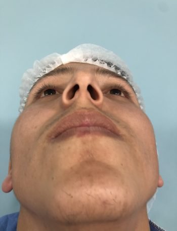 precio rinoplastia