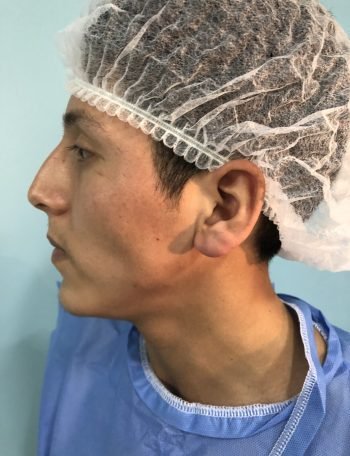 precio rinoplastia