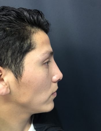 Cuál es el costo de una rinoplastia