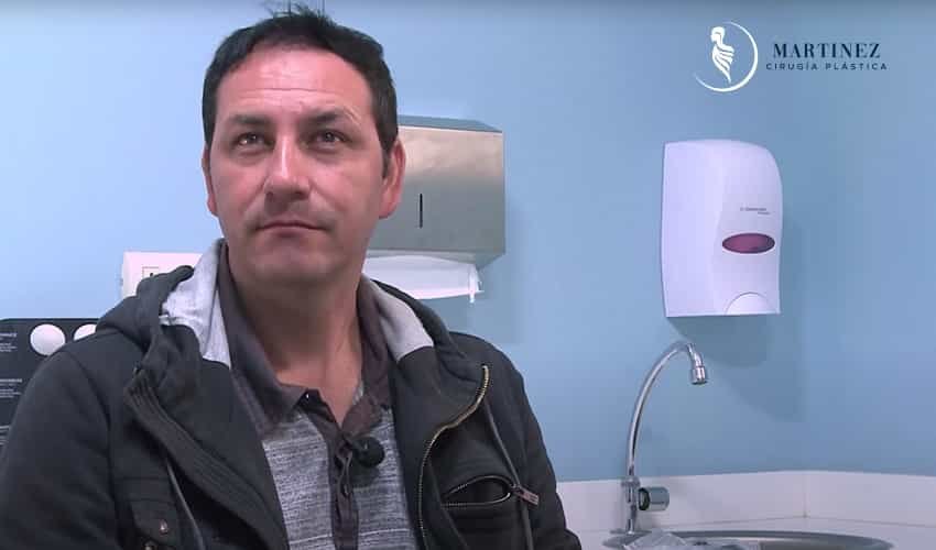 Implante de cabello – método FUE