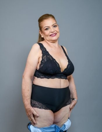 Después — Abdominoplastía