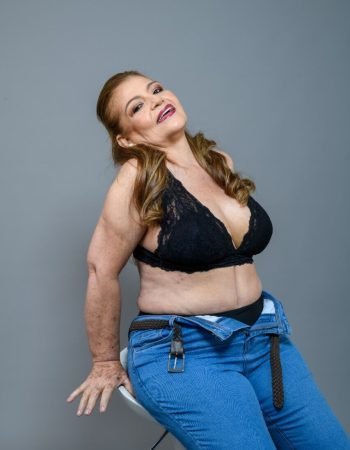 Después — Abdominoplastía