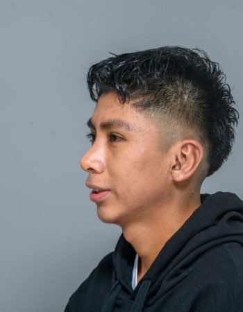 Después — Otoplastía