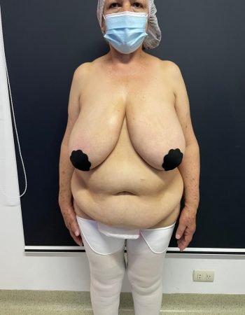 Antes — Abdominoplastía