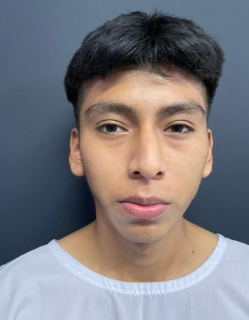 Antes — Otoplastía