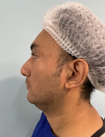 rinoplastia peru