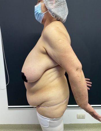 Antes — Abdominoplastía