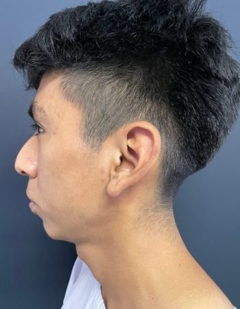 Antes — Otoplastía