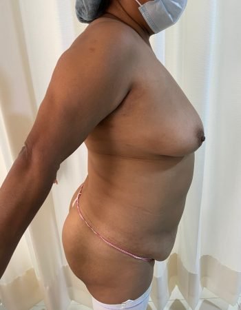 Antes — Abdominoplastía