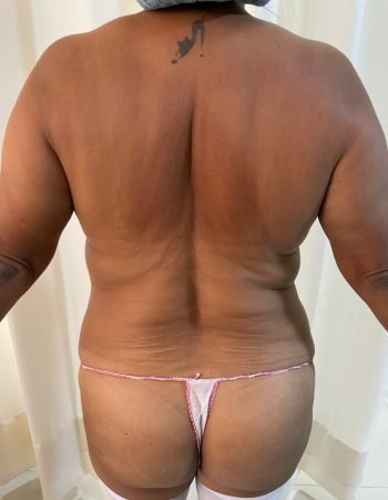 Antes — Abdominoplastía