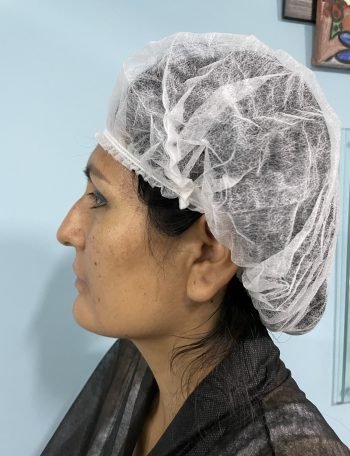 Fotos preoperatorias de una Rinoplastía | Foto 3